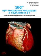 На фото ЭКГ при инфаркте миокарда с подъемом ST - Де Луна А.Б.