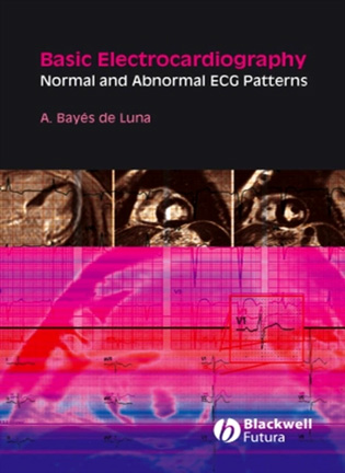 На фото Basic electrocardiography: normal and abnormal ECG patterns - Antoni Bayes de Luna