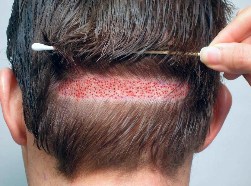​Пересадка волос методом FUE - что это?
