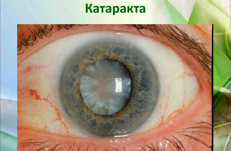 На фото Катаракта глаза: симптомы и лечение