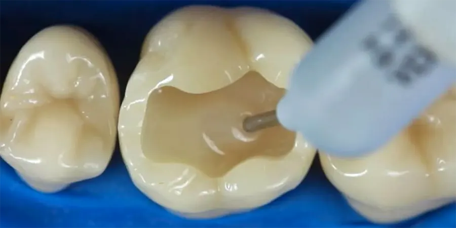 На фото Современная стоматология: пломбы и их виды