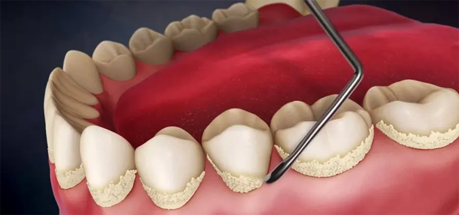 На фото Зубной камень - причины, симптомы, профилактика. Как удалить зубной камень?